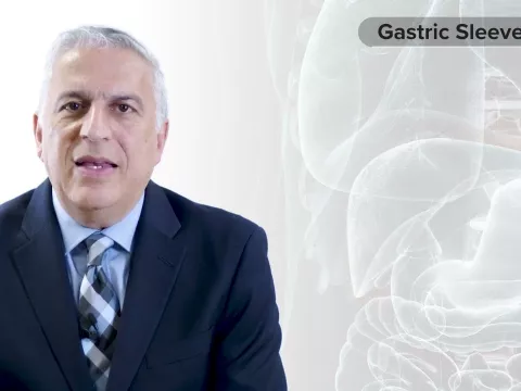 Procedure Overview: Gastric Sleeve with Dr. Vafa Shayani